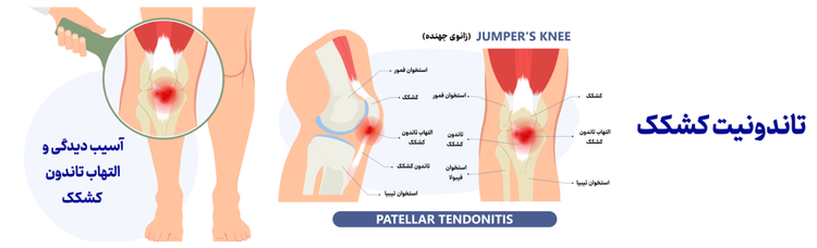 محافظ پیشرفته کشکک زانو اورتینو